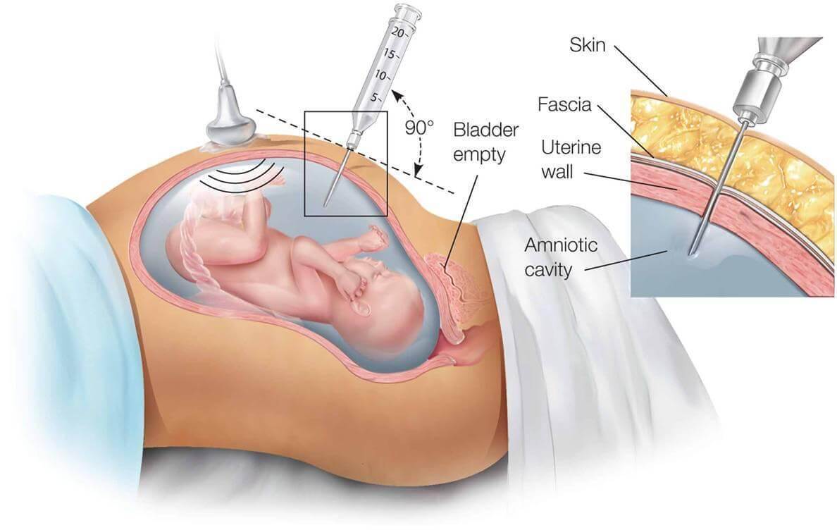 Amniocentesi